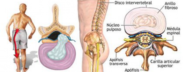 Hernia discal lumbar 